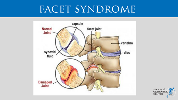 Facet syndrome back injury