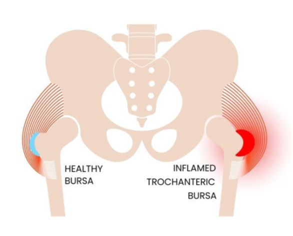 Hip injury RKS case study