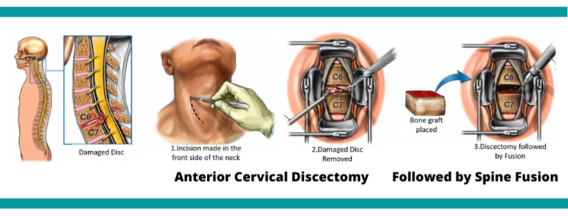 Spine fusion and cervical discectomy injuries