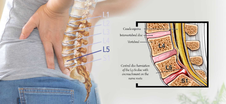 Back pain rear end collision 