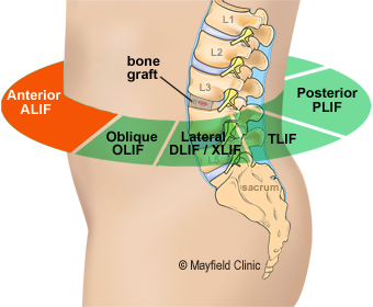 Spinal fusion injury from car wreck